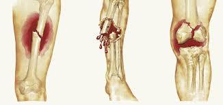 درمان شکستگی های استخوانی بزرگ با استفاده از سلول های بنیادی مزانشیمی