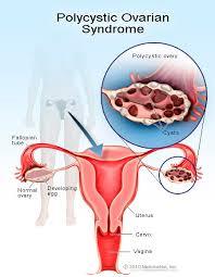 فعالیت فیزیکی به زنان مبتلا به سندرم تخمدان پلی کیستیک کمک می کند
