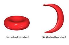 استفاده از سلول های بنیادی پرتوان القاشده برای درمان کم خونی داسی شکل