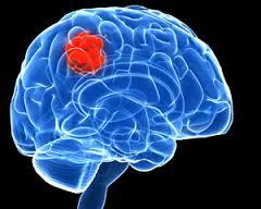 سرکوب یک پروتئین ترمیمی می تواند کلیدی برای درمان تومورهای مغزی باشد