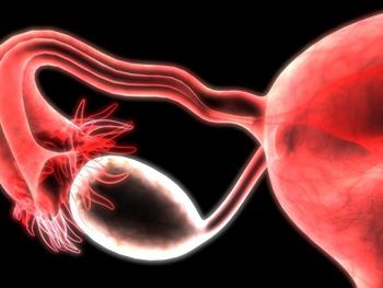 هدف قرار دادن سلول های شبه بنیادی برای ممانعت از عود مجدد سرطان تخمدان