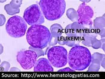 محصولی از سلول های بنیادی خون بند ناف برای لوکمیا و لنفوما
