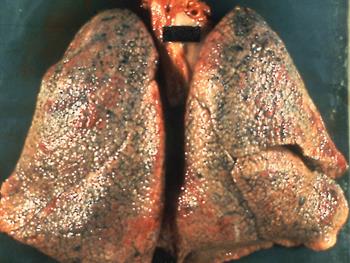 درمان مبتنی بر سلول های بنیادی برای تسکین علایم COPD