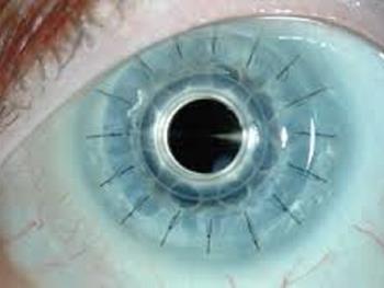 زیست پرینت سه بعدی: درمانی برای نابینایی قرنیه در آینده؟