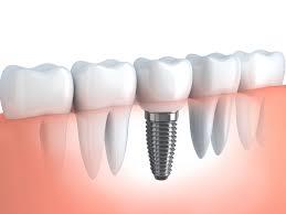 بهبود سازش پذیری ایمپلنت های دندانی با استفاده از سلول های بنیادی