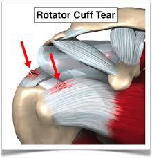 نوآوری در زمینه سلول های بنیادی می تواند به رشد مجدد عضلات گرداننده شانه(rotator cuffs) کمک کند