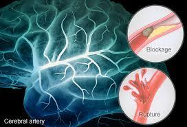 پیوند سلول های بنیادی عصبی القایی ریکاوری سکته را در موش بهبود می بخشد