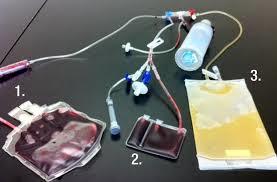 استفاده از سلول های بنیادی خون بند ناف برای کاهش خطر رد پیوند در بیمار چینی