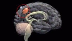تومورهای مغزی پرینت شده سه بعدی برای بهبود درمان ها