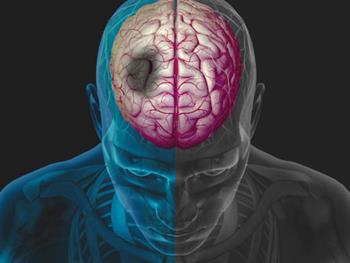 تلفیق نورون های پیوند شده به درون مغزهای رتی آسیب دیده از سکته
