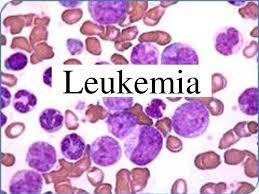 برای بیماران مبتلا به لوکمیای لنفوبلاستیک حاد منفی پیوند سلول های بنیادی خون ساز بهتر از شیمی درمانی است