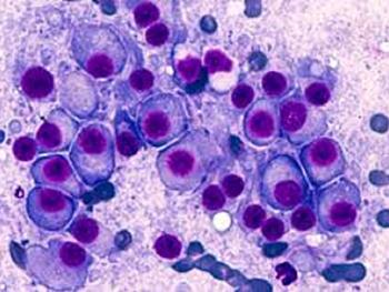پیوند سلول های بنیادی به بیمار سرطانی مبتلا به مولتیپل میلوما