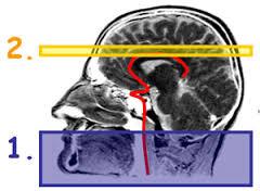 ابزاری برای شناسایی جریان خون مغزی که می تواند نشانه های اولیه زوال عقل و آلزایمر را نشان دهد