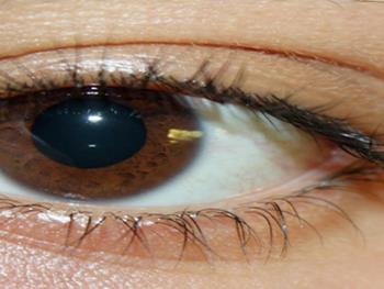درمان سوختگی چشم با اسید از طریق سلول درمانی