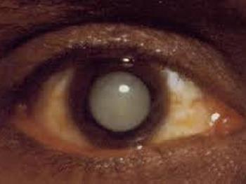 یک گام رو به جلو در سلول درمانی بیماری های چشمی