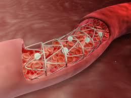 هم کشتی سلول های اندوتلیالی ترانسفکت شده با سلول های شریانی برای جلوگیری از بیماری رستنوز(restenosis)