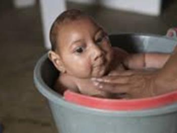 مبتلا شدن جنین موش آلوده به زیکا به میکروسفالی