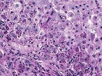 جمع آوری بزرگ ترین منبع سلول های بنیادی مشتق از بیماران مبتلا به نقص آلفا-1 آنتی تریپسین(AATD)