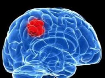 درمان دختربچه 4 ساله اسپانیایی مبتلا به سرطان مغز با استفاده از سلول های بنیادی خون بند ناف 
