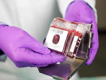 فاز یک کارآزمایی بالینی با پیوند هم زمان خون بند ناف و سلول های بنیادی مزانشیمی 