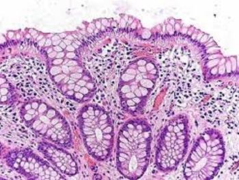 از دست رفتن سلول های گابلت روده ای بعد از پیوند سلول های بنیادی موجب مرگ می شود