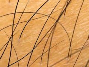کارآزمایی بالینی که نشان دهنده توانایی یک محلول موضعی مبتنی بر سلول های بنیادی برای رشد مو است