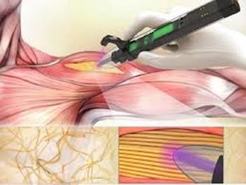 استفاده از پرینترهای دستی سه بعدی برای درمان آسیب های عضلانی اسکلتی