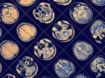 آستروسیت های مغزی تغییرات متابولیکی را در بیماری پارکینسون نشان می دهند