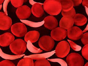 موفقیت ژن درمانی برای فرد مبتلا به بیماری کم خونی داسی شکل