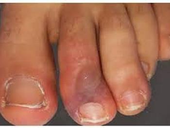 آیا "انگشت کرونایی" یکی از علایم واقعی کروناویروس است