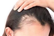درمان جدید علیه ریزش مو ناشی از خود ایمنی پوستی 