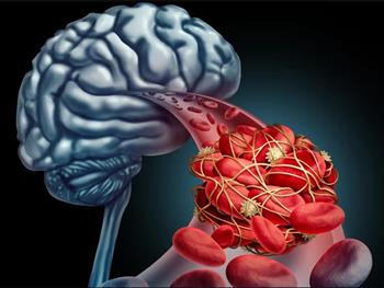 یک پروتئین خاص ممکن است روند بقای بیماران دچار خونریزی مغزی را تغییر دهد