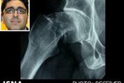 یافته‌های محقق ایرانی درباره تأثیر زمان جراحی بر بهبود شکستگی لگن