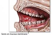 ارتباط بین پاسخ های التهابی نوتروفیلی و پراکنش سرطان دهان