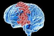 شناسایی یک بلوک کننده آنزیمی که رشد تومورهای مغزی کشنده را متوقف می کند