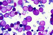 شناسایی یک هدف درمانی برای سلول های بنیادی لوکمیایی