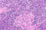 اغلب بیماران مبتلا به لنفومای سلول منتل به CAR T Cell درمانی پاسخ می دهند