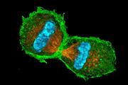 شناسایی اولین مبتلایان به بیماری جدید و نادر ناشی از نقص در تقسیم سلولی 