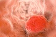 سلول‌های بنیادی و سرطان‌های کشنده گوارشی