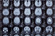 تشخیص سریع و دقیق بیماری آلزایمر با انجام اسکن مغزی