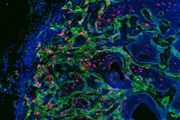 ارتباط سلول‌های بنیادی سرطانی با میکرومحیط التهابی پروتومورال 