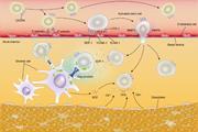 پیوند سلول‌های بنیادی آلوژنیک در درمان لوسمی میلوئید حاد 