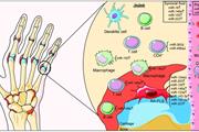 نقش miRNA ها در درمان آرتریت روماتوئید