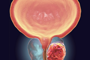 کمک به درمان و تشخیص بهتر سرطان پروستات با شناسایی یک عملکرد جدید