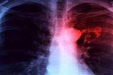 محققان امیدوارند پیوند سلول های بنیادی قلب بتواند به نارسایی قلبی کمک کند