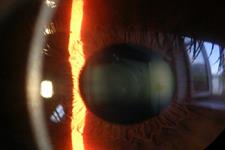 سلول های بنیادی بند ناف ممکن است بینایی از دست رفته در بیماری های قرنیه را بازگرداند