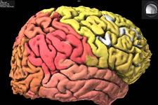 استفاده از سلول های بنیادی عصبی در درمان سکته مغزی