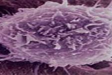 سلول های بنیادی پرتوان القایی  درمان جدیدی برای بیماری هانتینگتون