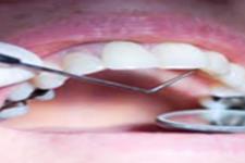 سلول های بنیادی دندان به عنوان هدف درمانی جدید