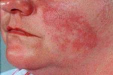 بیماری لوپوس همزمان در پوست و مفاصل می تواند بروز کند